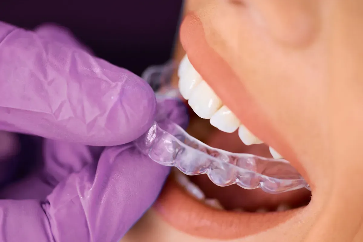 Umetanje Invisalign Udlage
