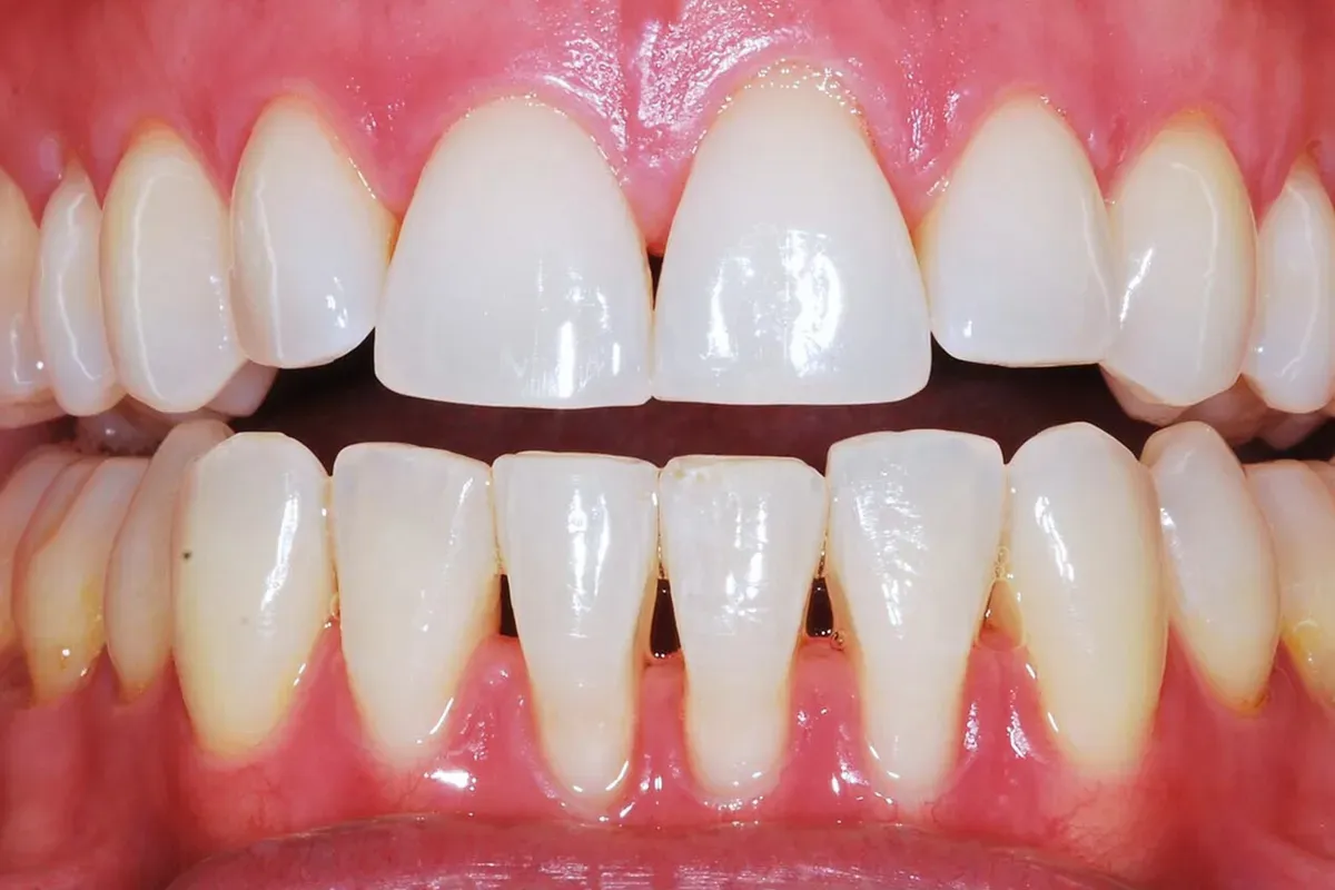 Prikaz Recesije Zuba