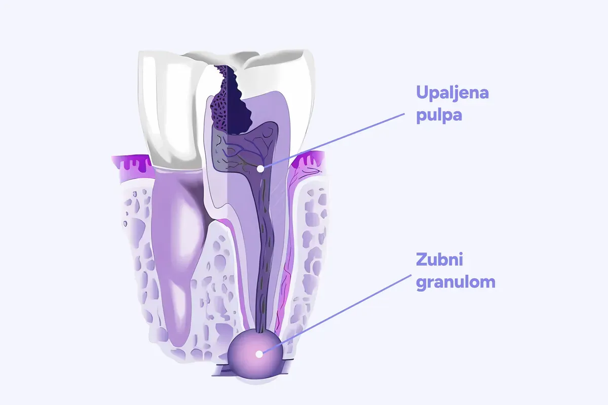 Imed Upala Pulpe Zubni Granulom