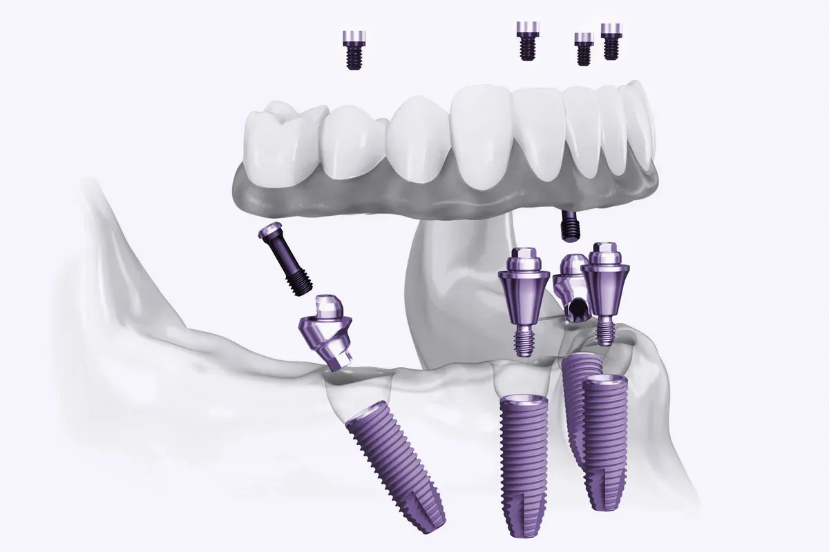 Imed All on 4 Koncept Donja Celjust