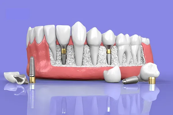 Imed Blog Implantati Titan 1