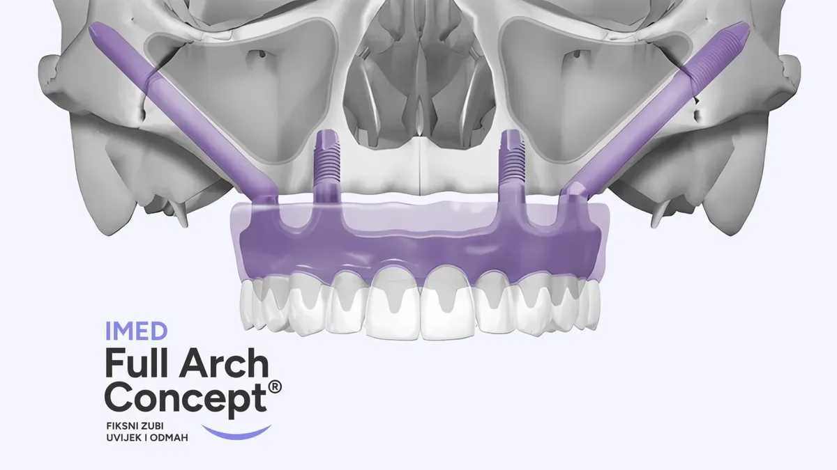 Imed Blog Full Arch Treatment 1