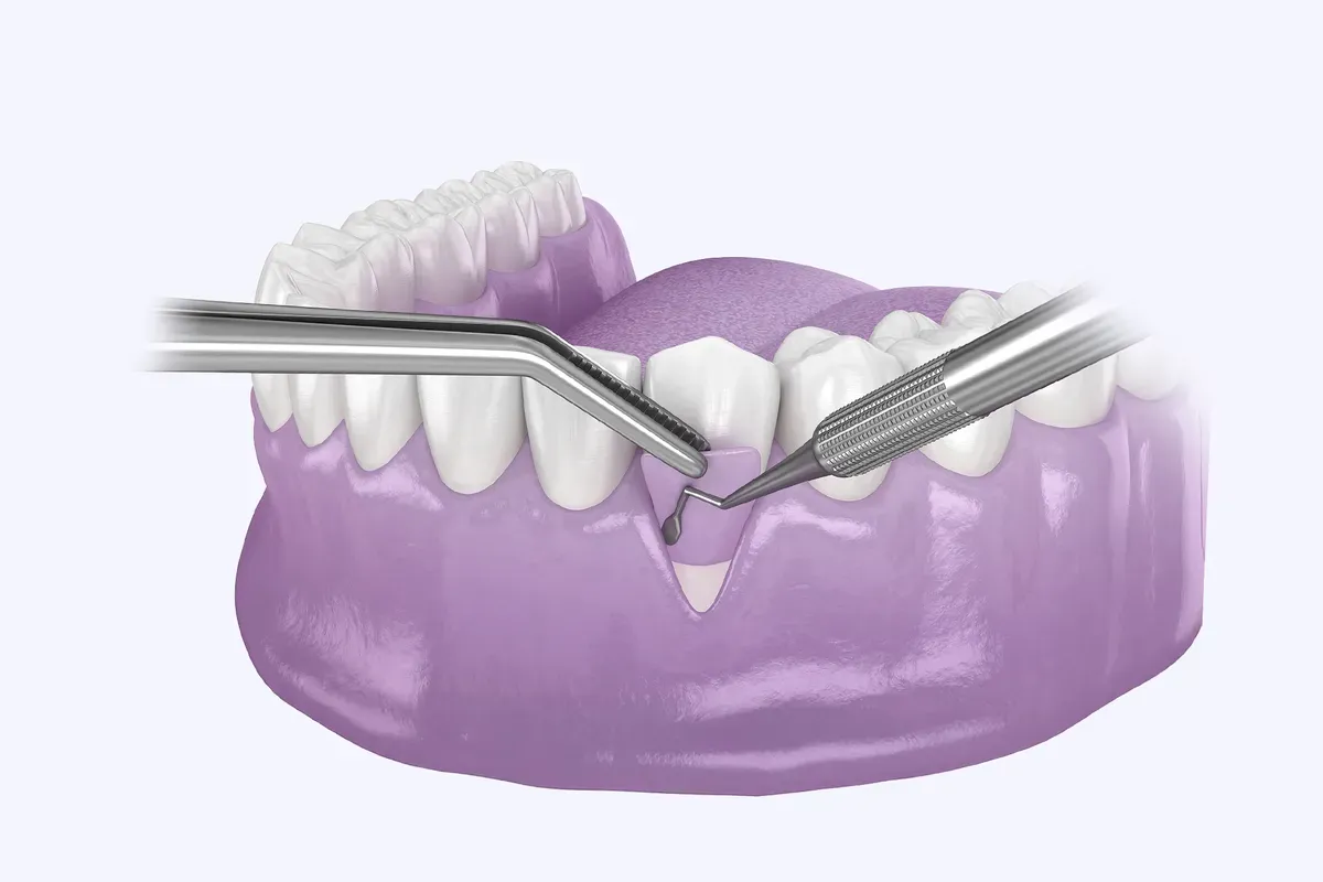 Imed Zatvaranje Recesija