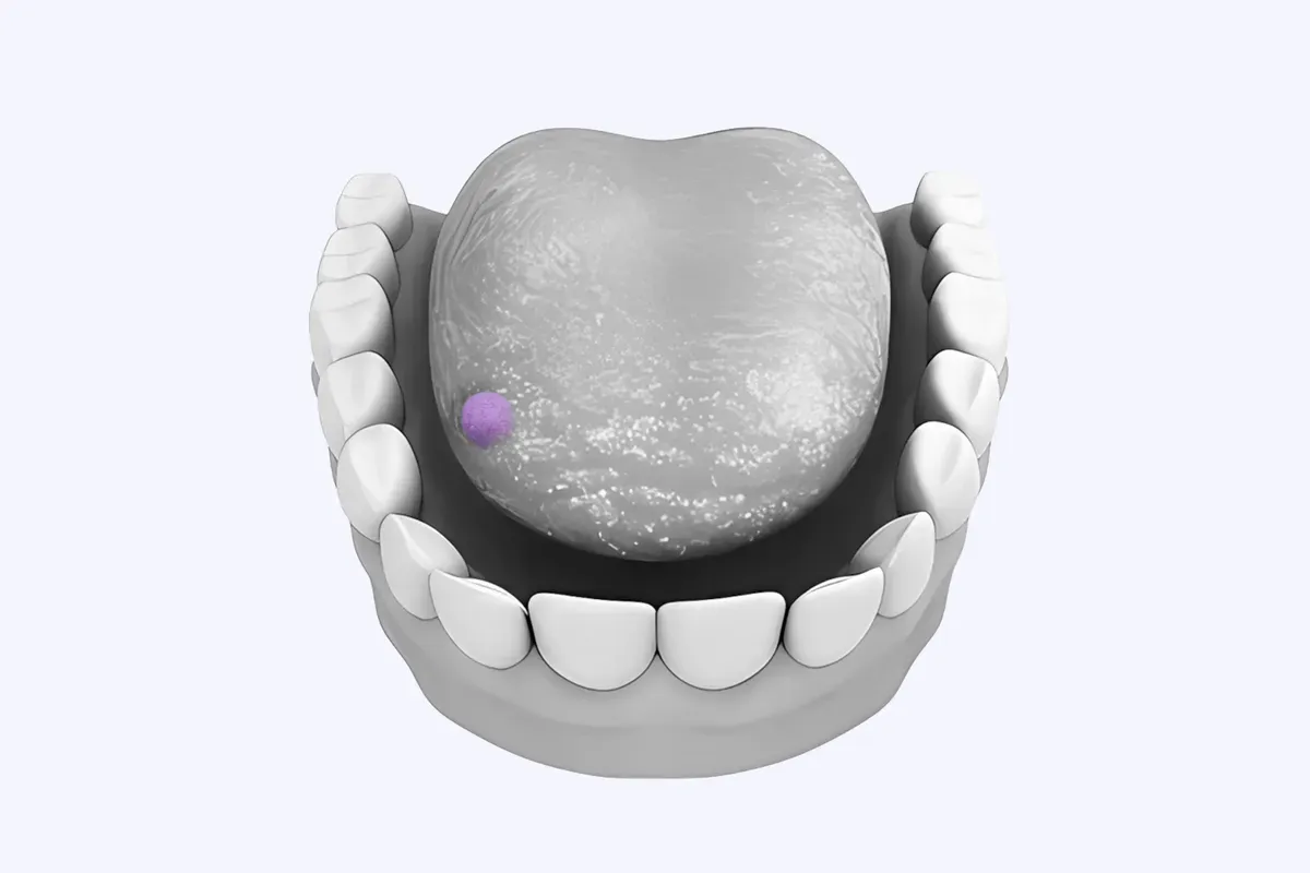 Ekscizija Benignih Tvorbi Usne Supljine