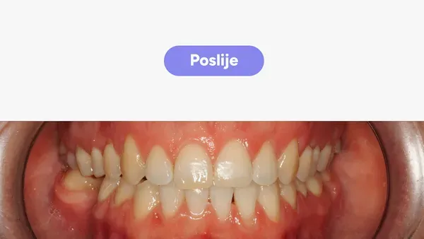 Orto Tea S Fullface Poslije V2