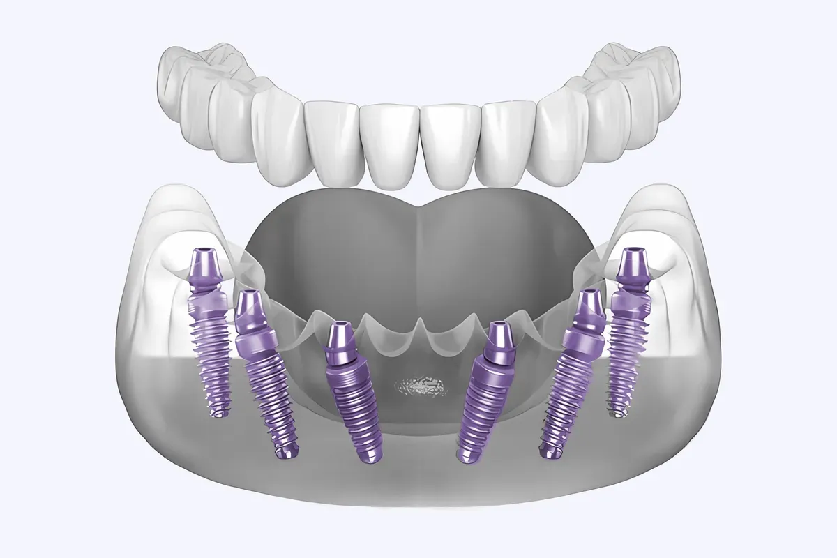 Imed All on 6 Implantati Donja Celjust