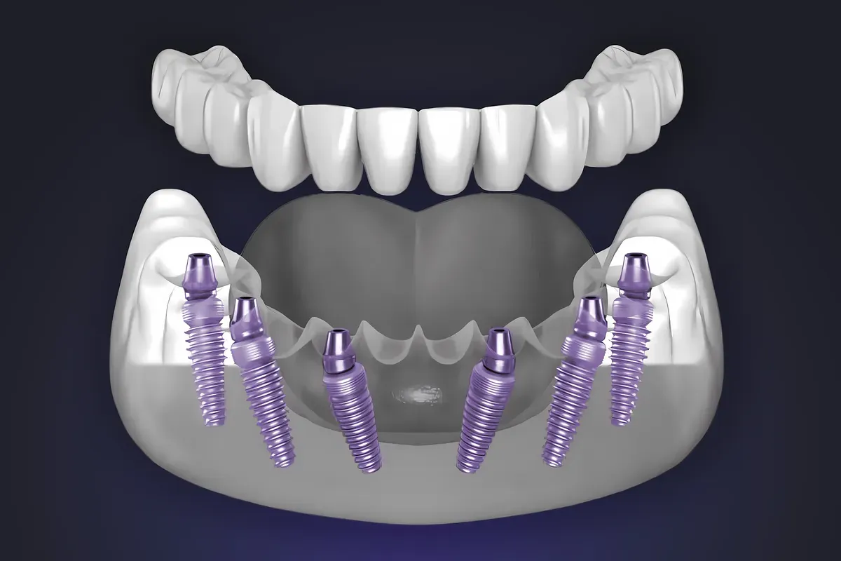Imed Semicirkularni Most Na Implantatima 