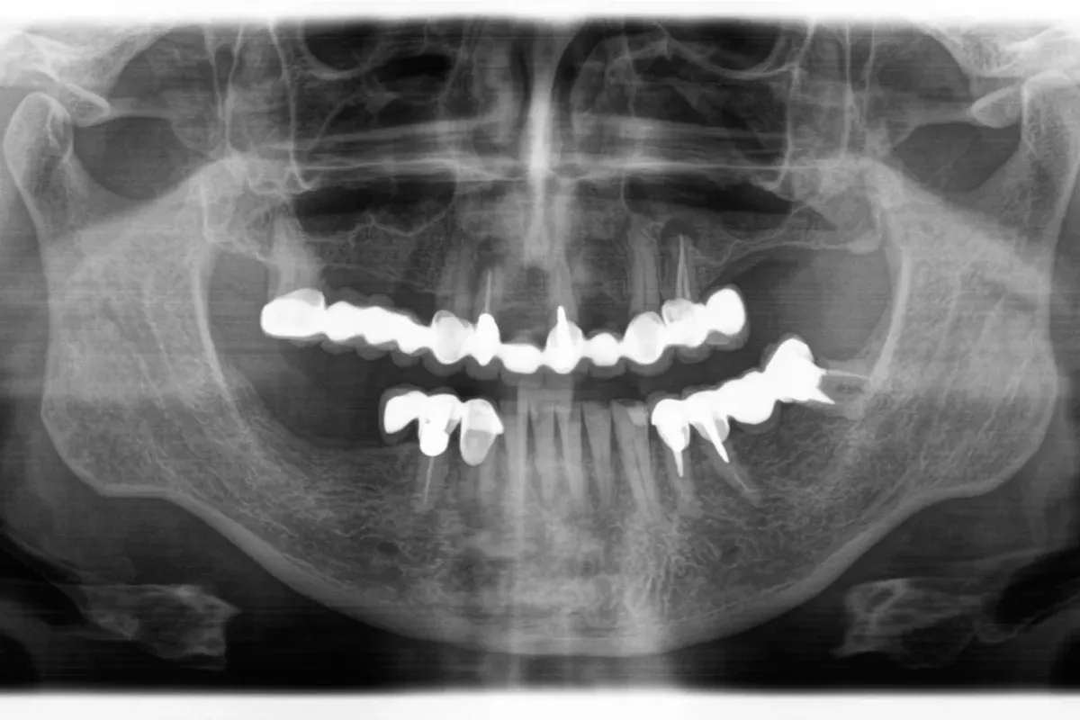 Endodoncija Rtg Snimka Nakon Liječenja