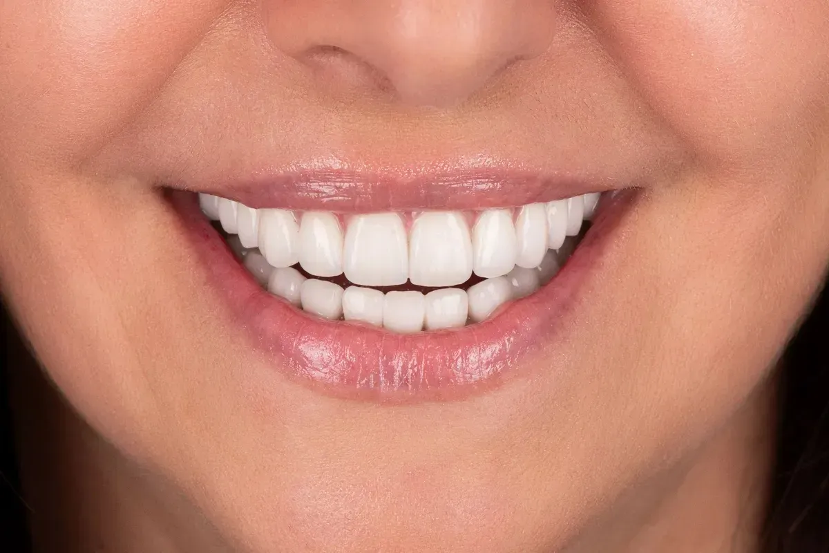 zenski-osmijeh-porculanski-zubi