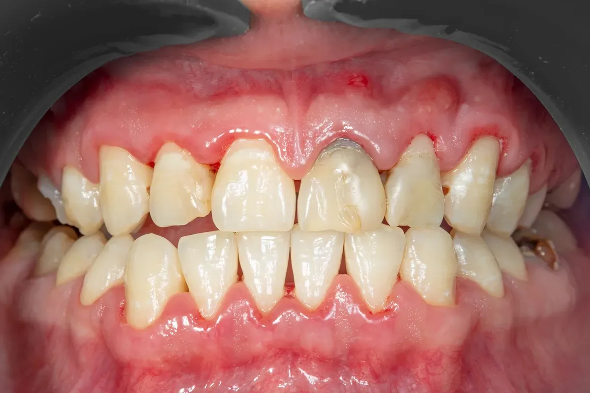 parodontoza-upaljene-desni