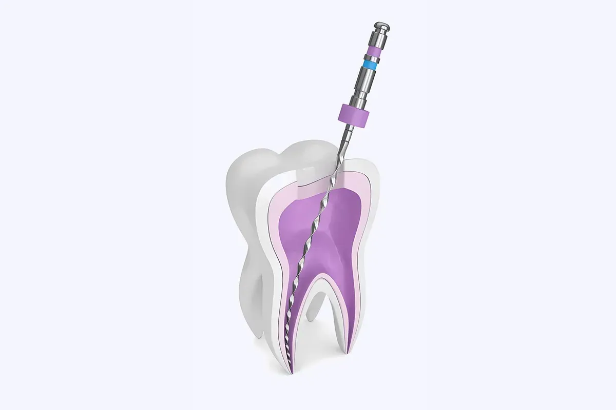 Imed Endodoncija Revizija Liječenja