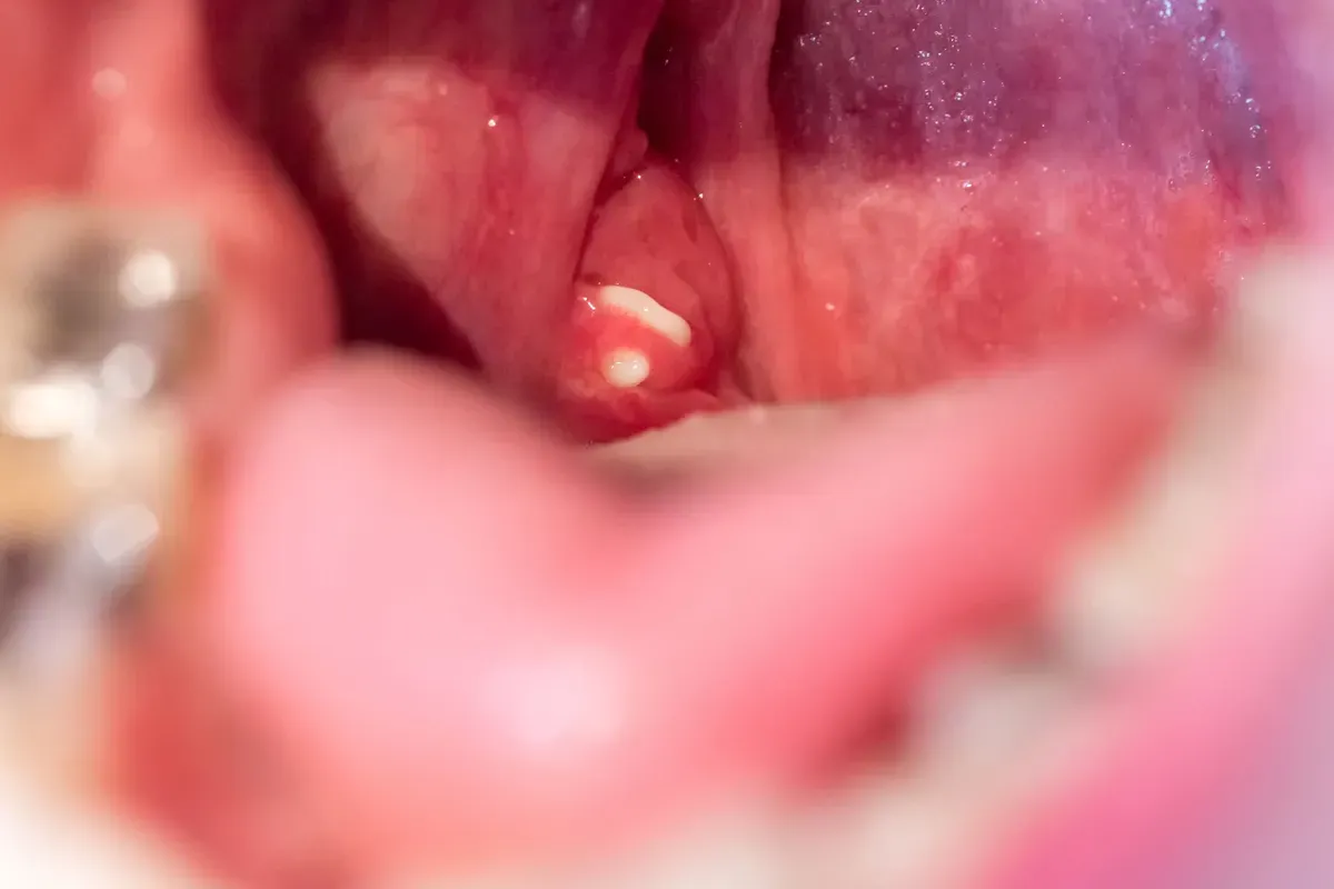 Upaljeni Krajnici Tonzile