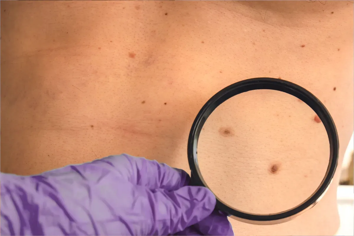 Dermatoskopski Pregled Madeza
